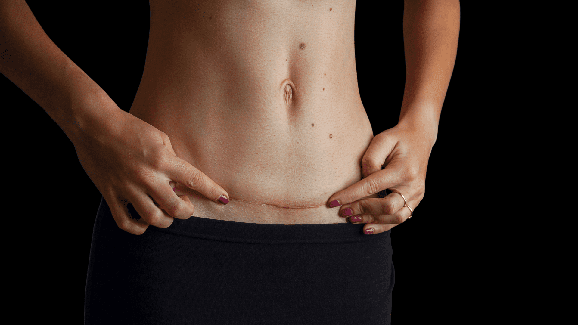 scar after abdominoplasty